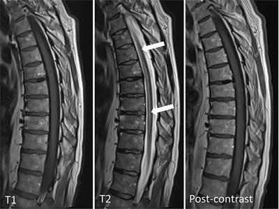 Case report: Dueling etiologies: Longitudinally extensive spinal cord lesion mimicking spinal cord infarct with simultaneous positive Lyme serology and amphiphysin antibody